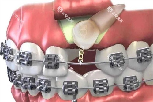牙齿牵引 牙齿牵引