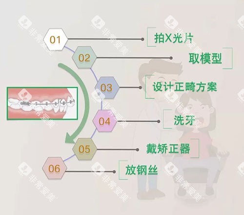 牙齿矫正流程