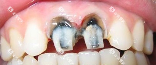 烤瓷牙前牙齿的情况 烤瓷牙前牙齿的情况