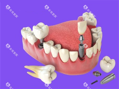 多颗种植牙漫画图 多颗种植牙漫画图