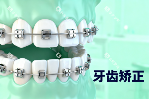 传统牙齿矫正方式展示