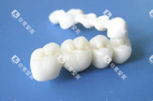 全瓷牙冠模型一览图
