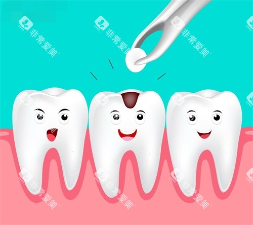 补牙示意图