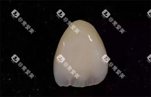 单颗全瓷牙示意图