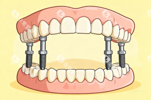 全口种植牙一览