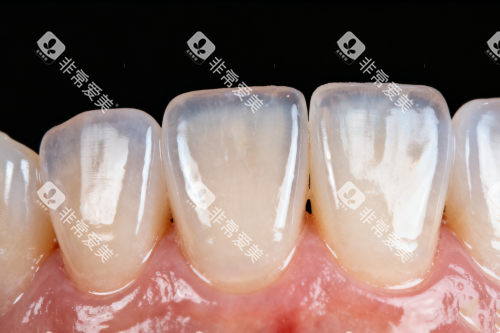 牙齿发黄卡通展示图