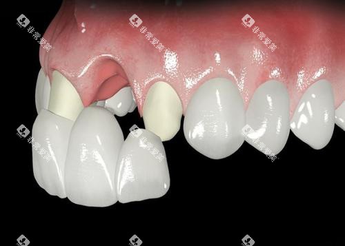 前牙全瓷牙展示