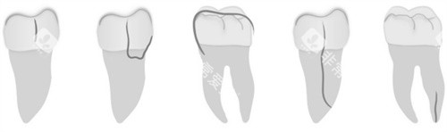 牙齿裂纹方向 牙齿裂纹方向