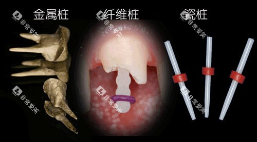 牙齿打桩材质 牙齿打桩材质