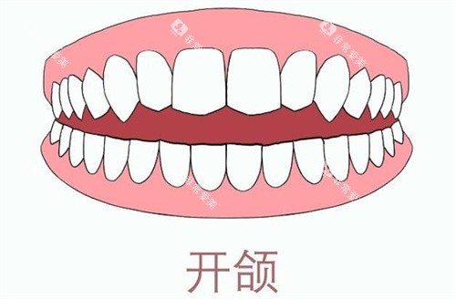牙齿开颌