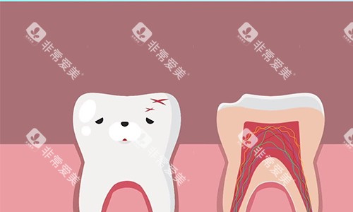根管治疗的流程示意图