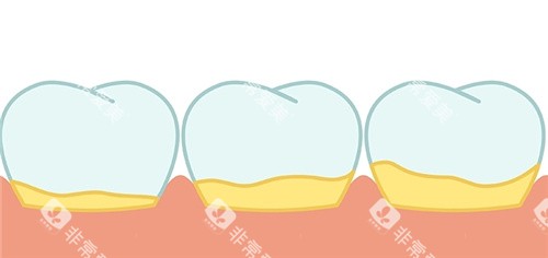 牙齿有牙结石 牙齿有牙结石