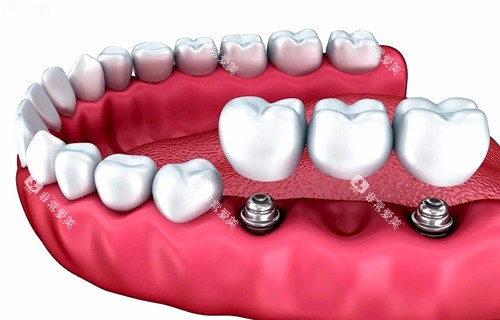 多颗种植牙种植模型示意图 多颗种植牙种植模型示意图