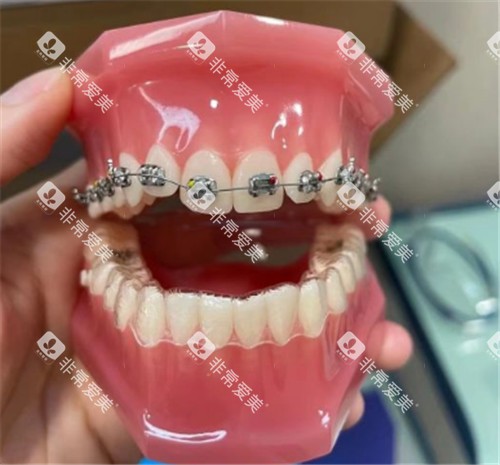 金属托槽矫正牙模 金属托槽矫正牙模