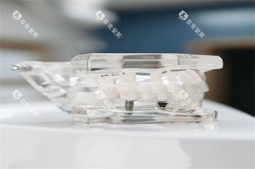 种植牙模型示意