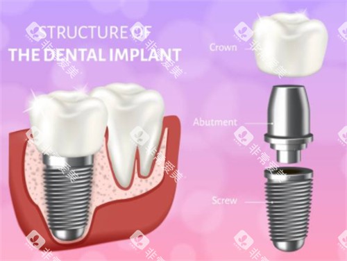 种植牙模拟示意图
