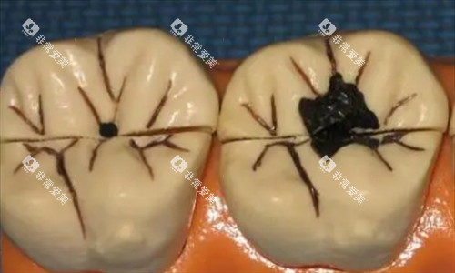 龋齿牙齿模型展示