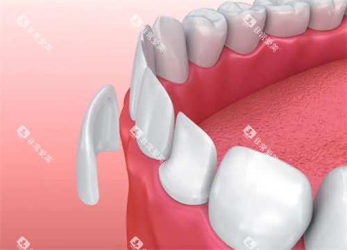 牙齿贴片