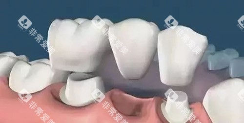 固定假牙连桥示意图 固定假牙连桥示意图