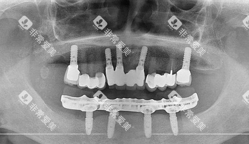 全口种植 全口种植