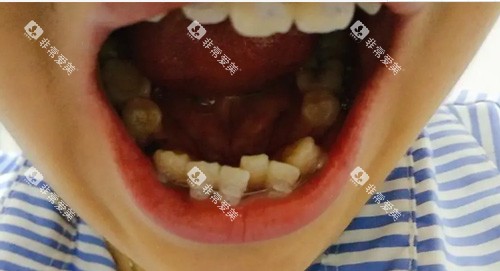 牙齿拥挤口腔内部图 牙齿拥挤口腔内部图