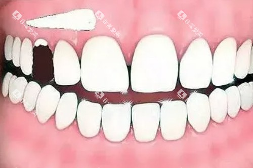 牙齿缺损卡通图 牙齿缺损卡通图