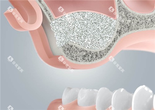 植骨种植牙 植骨种植牙