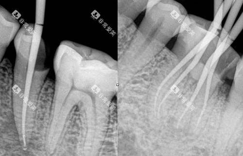 根管治疗ct照片 根管治疗ct照片