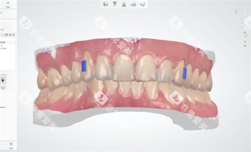 牙齿矫正方案设计中 牙齿矫正方案设计中