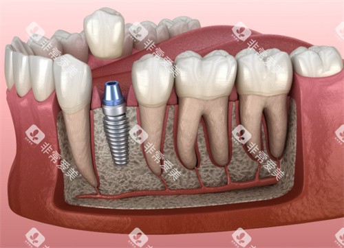 种植牙解剖模型 种植牙解剖模型