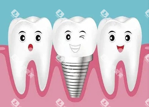 种植牙和真牙卡通示意图 种植牙和真牙卡通示意图