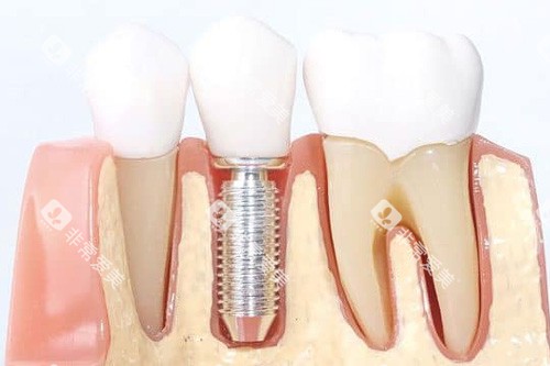 单颗种植牙模型图 单颗种植牙模型图