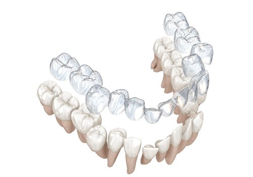 隐形矫正牙齿过程 隐形矫正牙齿过程