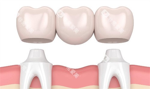 牙冠三联桥 牙冠三联桥