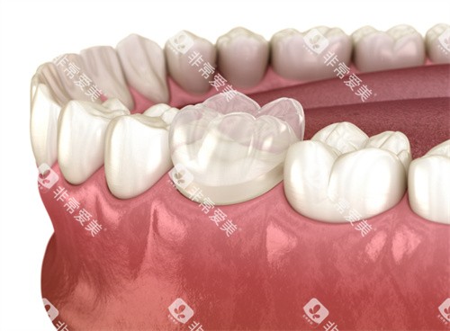 牙齿全瓷冠 牙齿全瓷冠