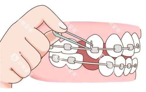 牙齿矫正上皮筋漫画图