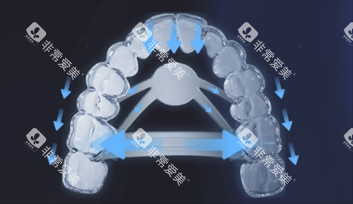 正雅隐形矫正s11牙齿位移变化 正雅隐形矫正s11牙齿位移变化