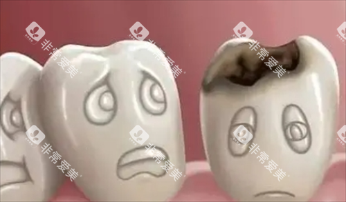 烂牙齿动画展示 烂牙齿动画展示