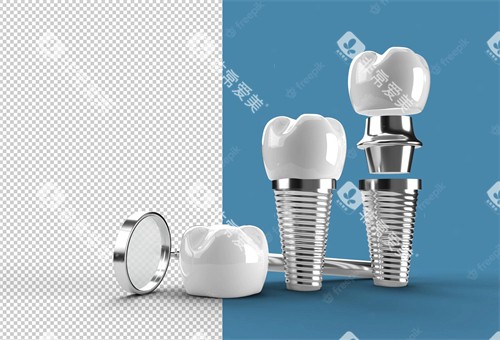 种植牙手术图示