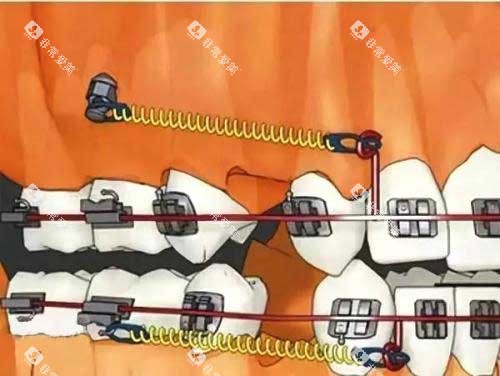 拔牙矫正骨钉种植钉