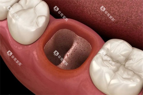 拔牙洞内部白色膜