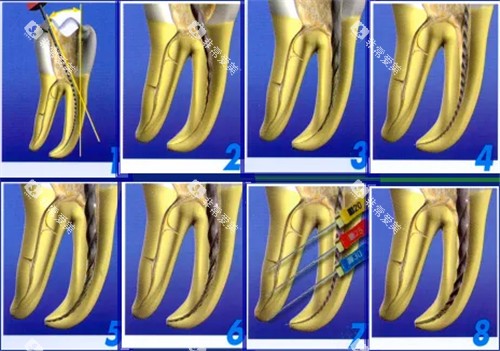根管治疗步骤图细节