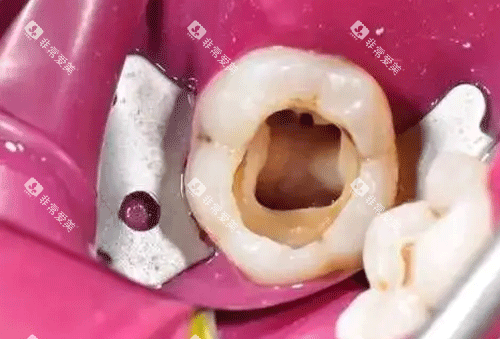牙齿根管治疗图片