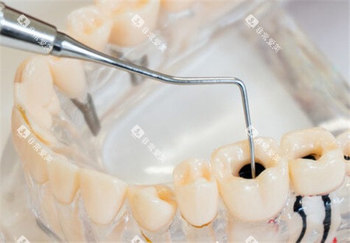 牙齿龋坏模型 牙齿龋坏模型