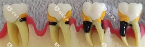 龋坏过程图 龋坏过程图