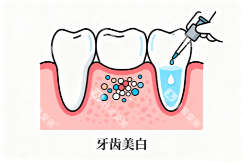 牙齿美白卡通展示图
