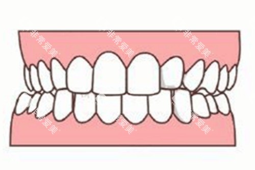 牙齿轻微畸形卡通图