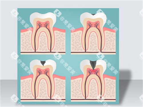 不保护牙齿的危害