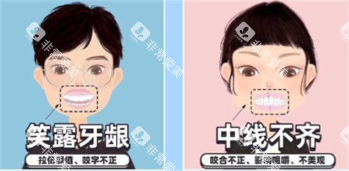 需要矫正的牙齿图解