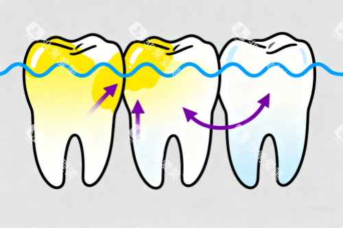 牙齿美白变化图 牙齿美白变化图